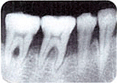 歯周病（重度）